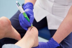 A medical professional wearing purple gloves draws a line on a patient's heel with a marker, likely preparing for a procedure or treatment at UON's Podiatry Clinic.